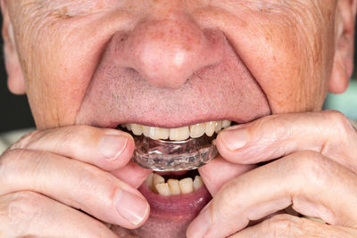 Close-up of man with night guard in mouth