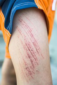 Cropped image of scratched leg