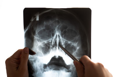 The doctor examines the x-ray of the sinuses.