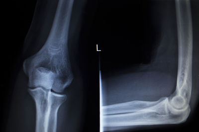 X-ray image of bone