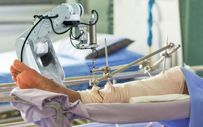 Close-up of fractured leg on hospital bed