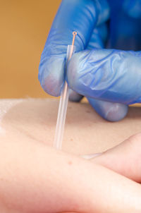 Cropped hand giving acupuncture massage to patient in hospital