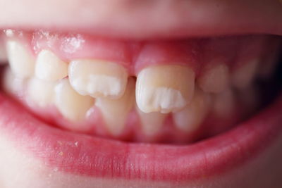 Cropped image of damaged teeth