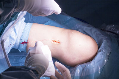 Cropped hands of doctor performing operation on patient knee in hospital