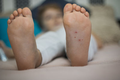 Low section of boy with chickenpox on foot 