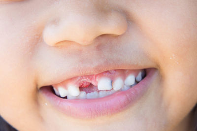 Close-up of smiling child with tooth gap
