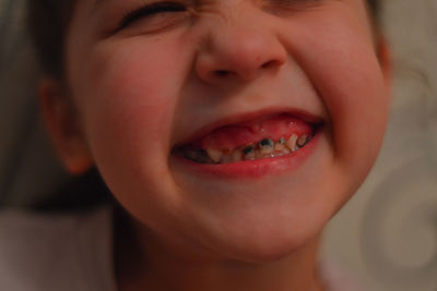 Little boy show broken teeth.boy with a broken and rotten teeth. a large portrait. 