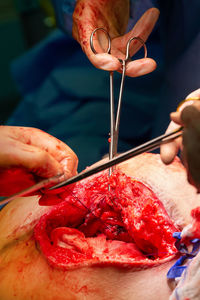 Surgery in progress. closeup on operating field and hands of surgeons.