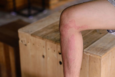 Close-up of allergy on leg