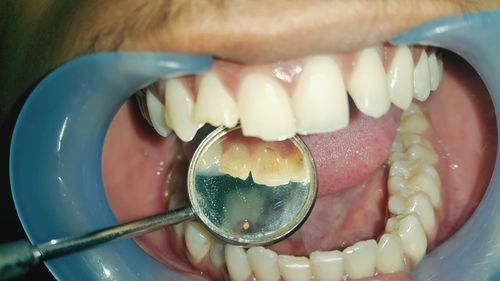 Close-up of angled mirror in young woman mouth