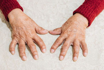 Hands of elderly woman with rheumatoid arthritis