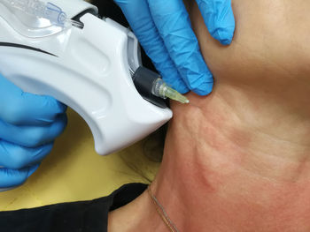 Neck rejuvenation with carbon dioxide, carboxytherapy, getting rid of wrinkles and a second chin 