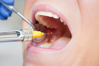 Close-up of dentist examining patient teeth