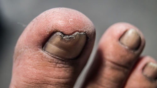 Close-up of human broken nails toes