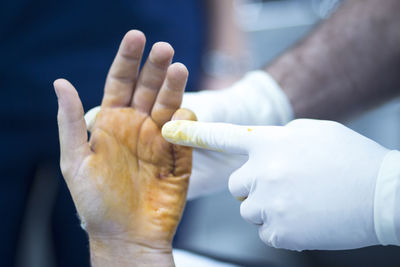 Cropped image of doctors examining wounded patient hand