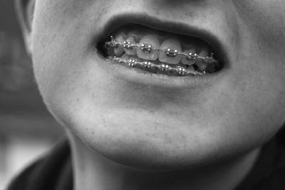 Cropped person with braces