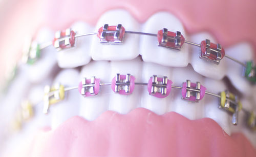 Close-up of dentures with braces