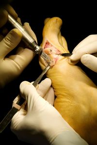 Close-up of the hands of surgeons operating on foot