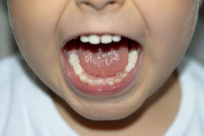 A little boy with an open mouth showing milk teeth and constantly growing teeth.