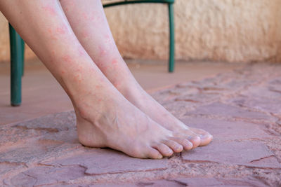 Girl's legs bitten by mosquitoes, close-up. woman scratching her feet bitten by insects.