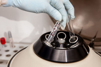 Scientist preparing a peritoneal fluid sample for cytology analysis in the laboratory. 