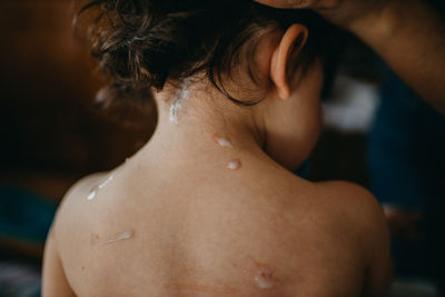 Close-up of shirtless child with chickenpox