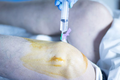 Close-up of patient with medicine applied on knee in operating room