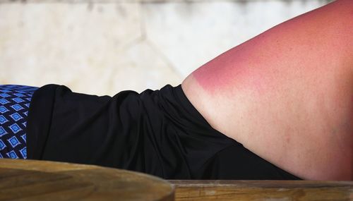 Midsection of woman with sunburn lying down