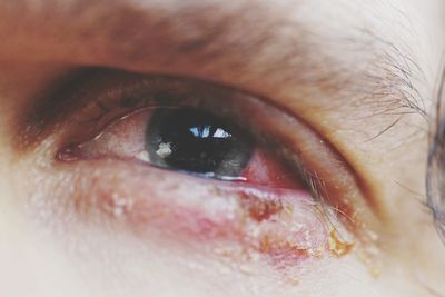 Close-up of sore eye