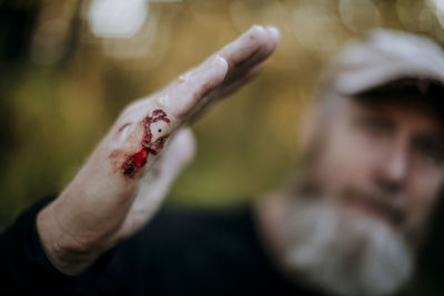 A closeup of a man with a bloody cut on his hand, starting to scab.
