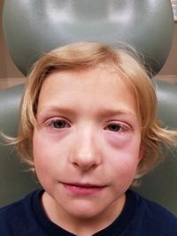 Close-up portrait of boy suffering from eye allergy