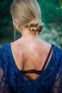 Back of a woman in mosquito bites