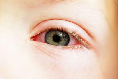 Close-up of boy with conjunctivitis