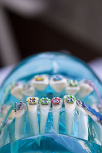 Close-up of blue plastic denture with braces