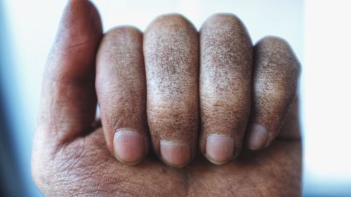 Close-up of hand with disease