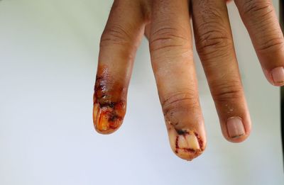 Cropped hand of injured man