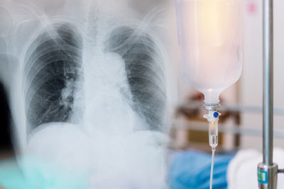 X-ray image of human lungs for a medical coronavirus covid-19 diagnosis. and normal saline solution