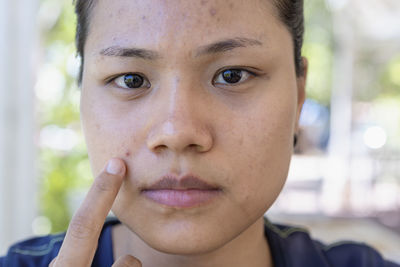 Young asian woman worry about her face when she has problems with skin on her face in a  nature.