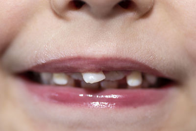 Little boy with open mouth showing milk teeth in front and growing permanent teeth.