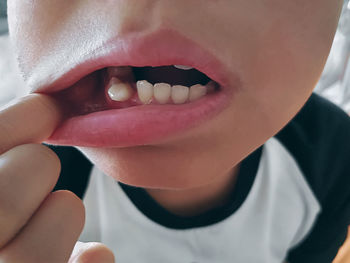 Close-up of boy showing broken tooth