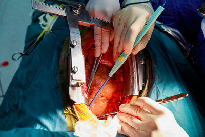 Cropped hands of doctors doing surgery of patient