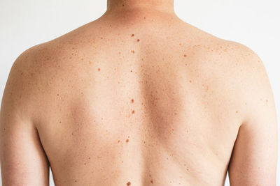 Pigmentation. close up detail of the bare skin on a man back with scattered moles and freckles.