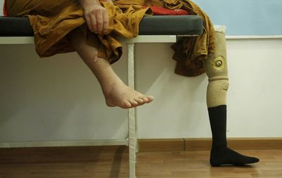 Patient using prosthetic leg