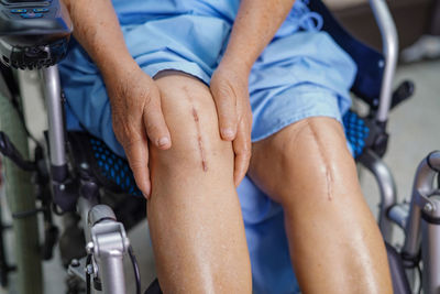 Midsection of patient with scars on knees sitting on wheelchair