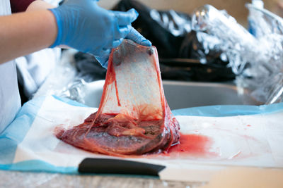 Gloved hands holding open amniotic sac attached to placenta.