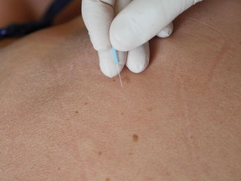 Close-up of cropped hand of doctor inserting needle in person skin