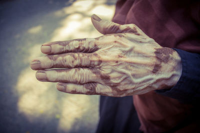 Close-up of affected hand by leukoderma