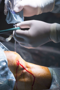 Cropped hands of surgeon operating patient at hospital