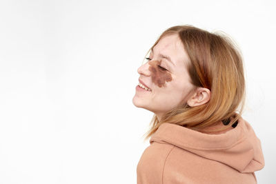 Close-up of young woman with birthmark against white background