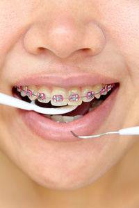 Close-up of woman wearing braces